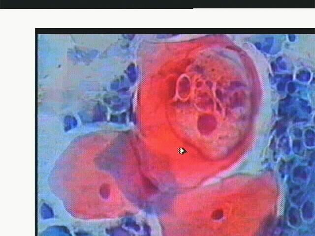 https://www.gyn.gr/images/Koilozyt-herpes_copy.jpg